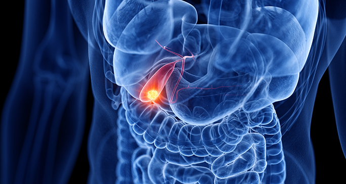 Gallbladder Cancer