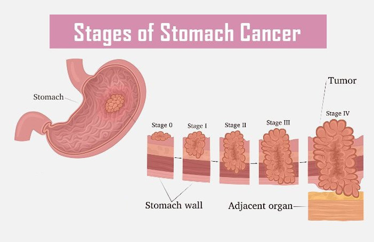 Gastrointestinal Cancer specialist in Faridabad 
